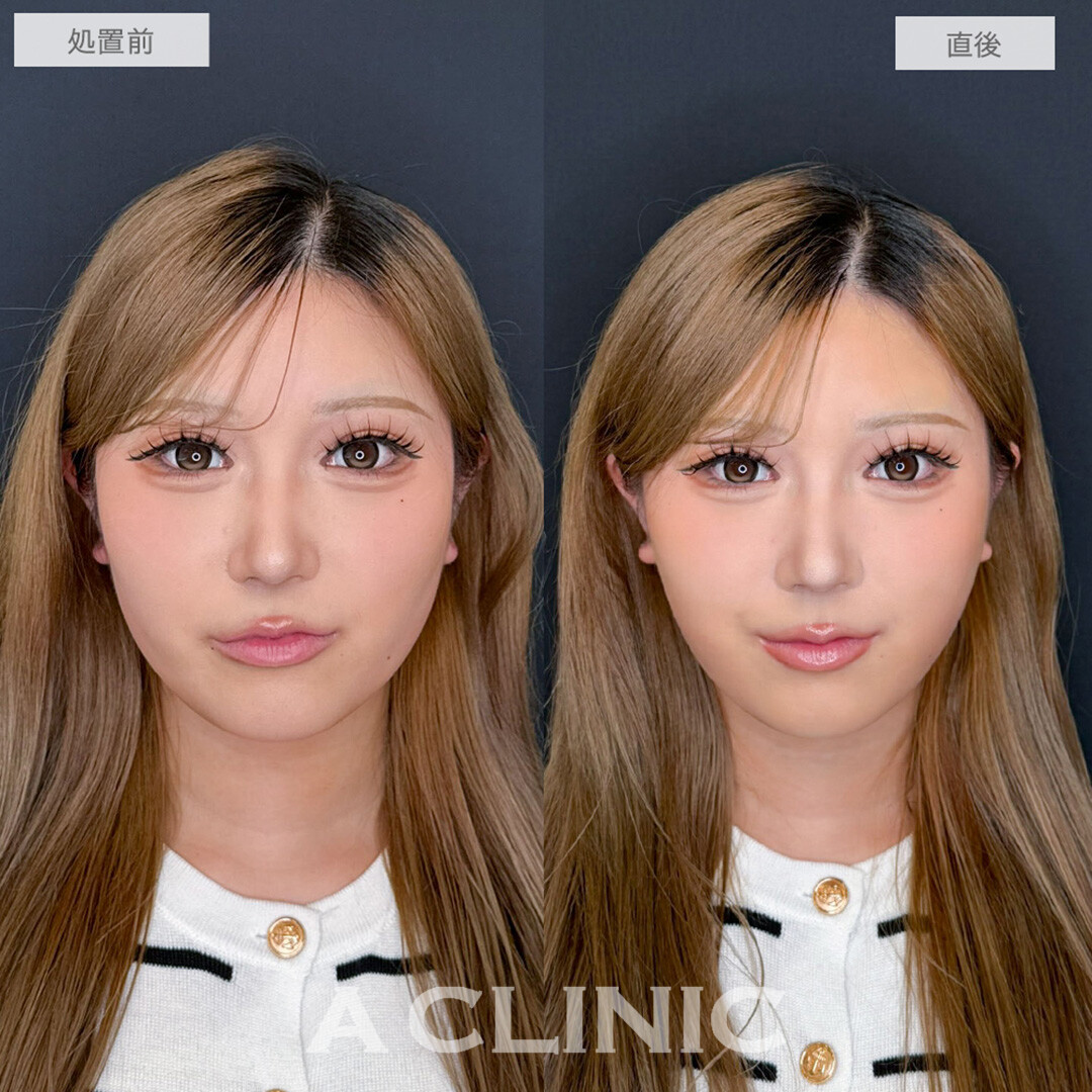 1day小顔脂肪吸引で直後から憧れのVフェイスに！処置前と直後の症例です(20代女性)