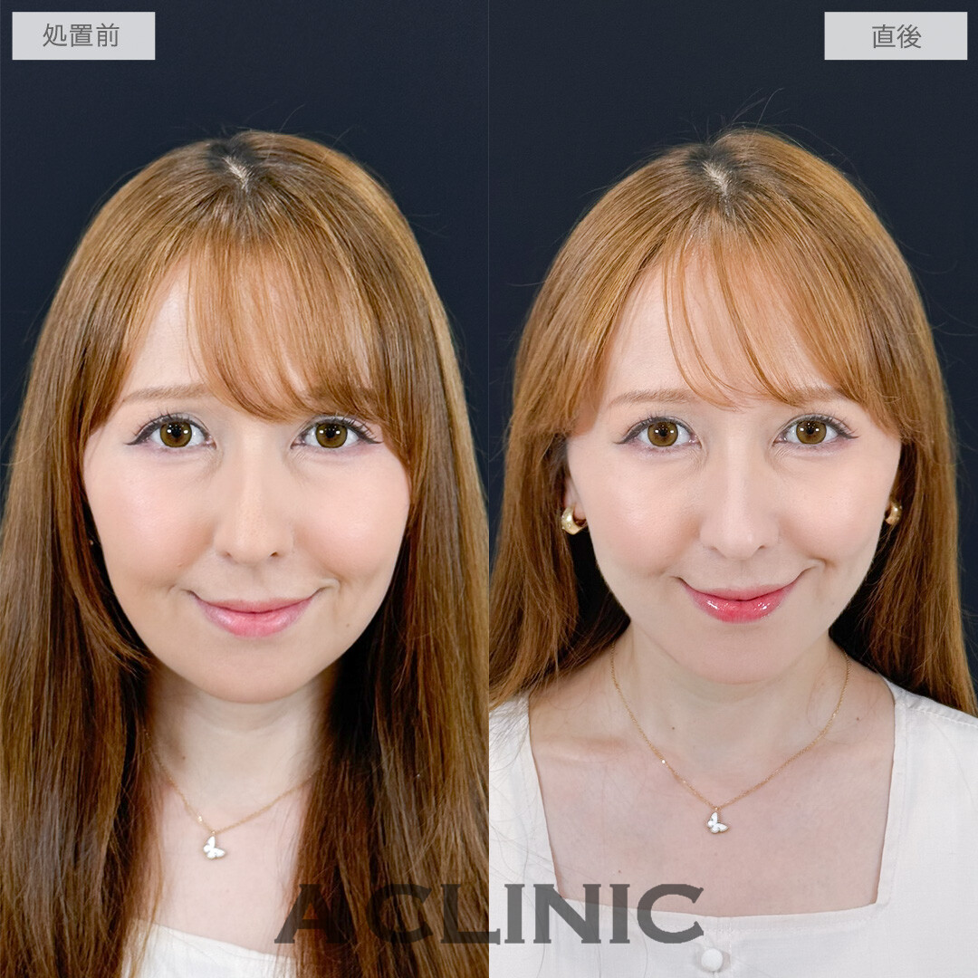 1day小顔脂肪吸引で老け見え要因の脂肪をスッキリなくせました！処置前と直後の症例です(40代女性)
