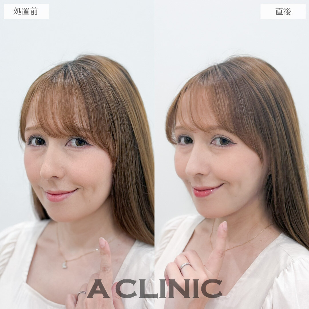 1day小顔脂肪吸引で老け見え要因の脂肪をスッキリなくせました！処置前と直後の症例です(40代女性)