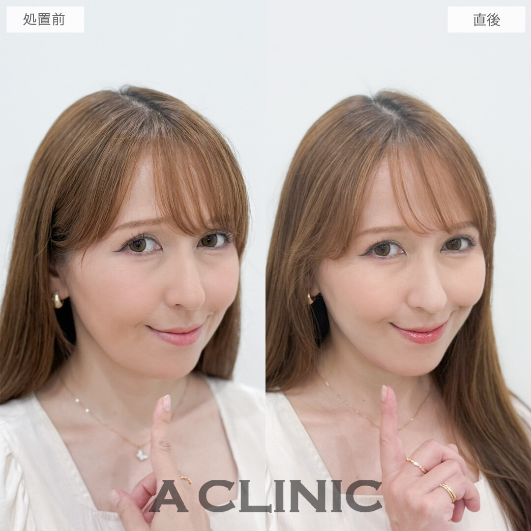 1day小顔脂肪吸引で老け見え要因の脂肪をスッキリなくせました！処置前と直後の症例です(40代女性)