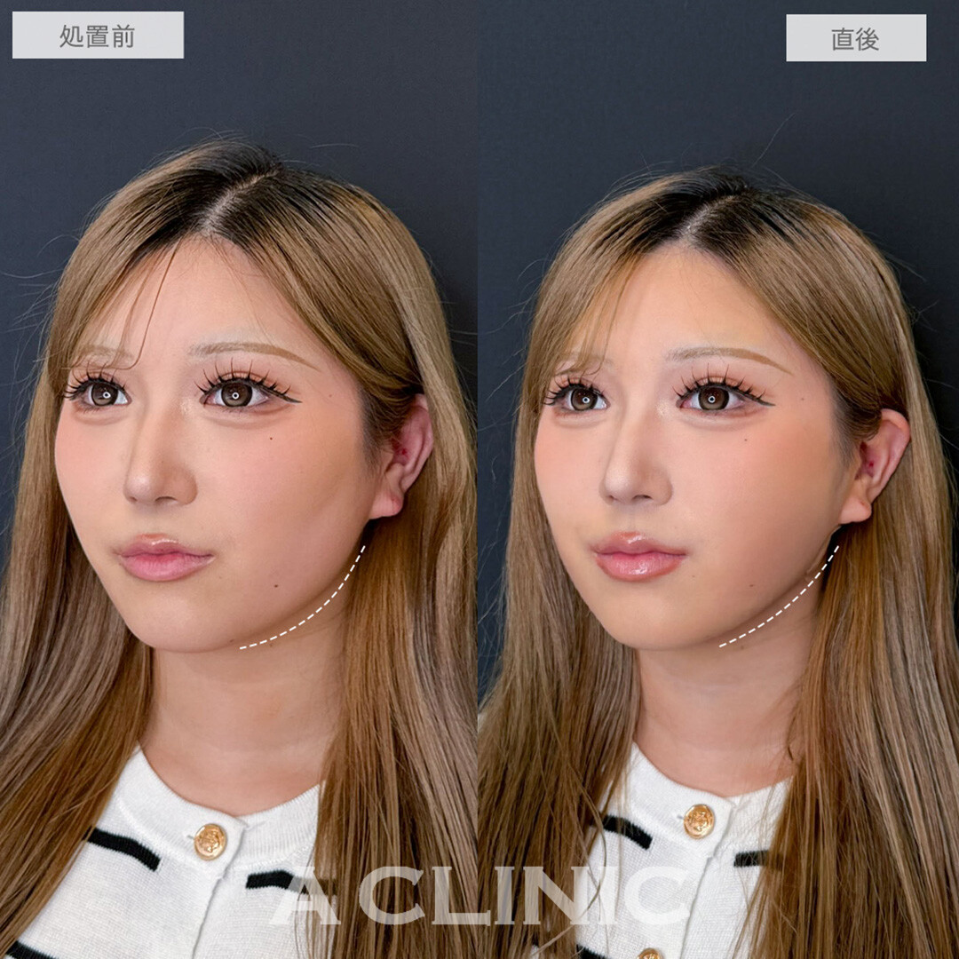 1day小顔脂肪吸引で直後から憧れのVフェイスに！処置前と直後の症例です(20代女性)