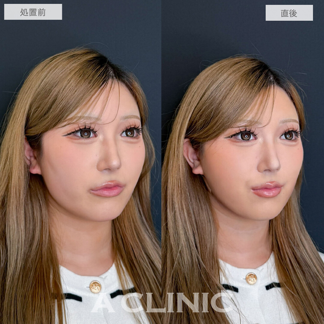 1day小顔脂肪吸引で直後から憧れのVフェイスに！処置前と直後の症例です(20代女性)