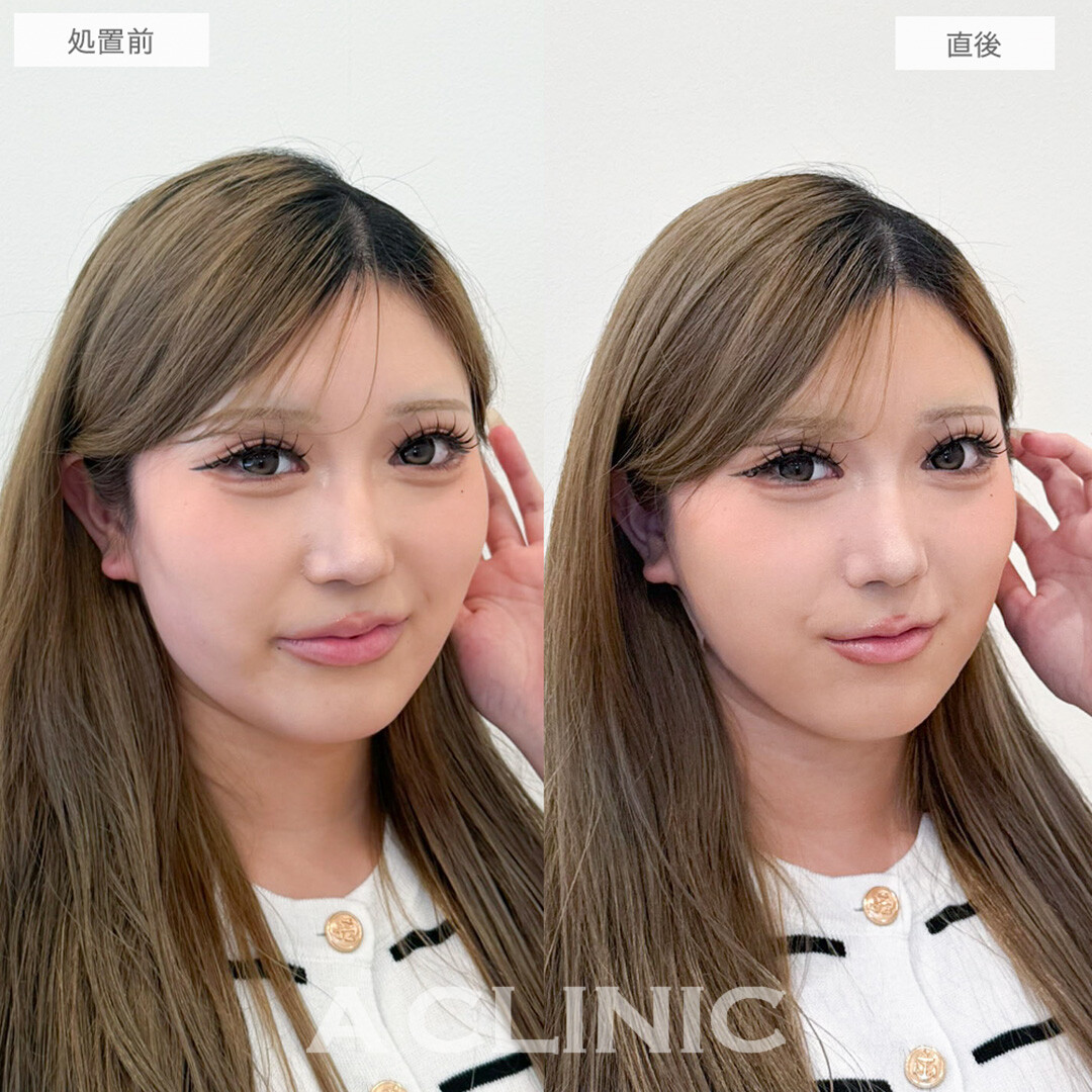 1day小顔脂肪吸引で直後から憧れのVフェイスに！処置前と直後の症例です(20代女性)