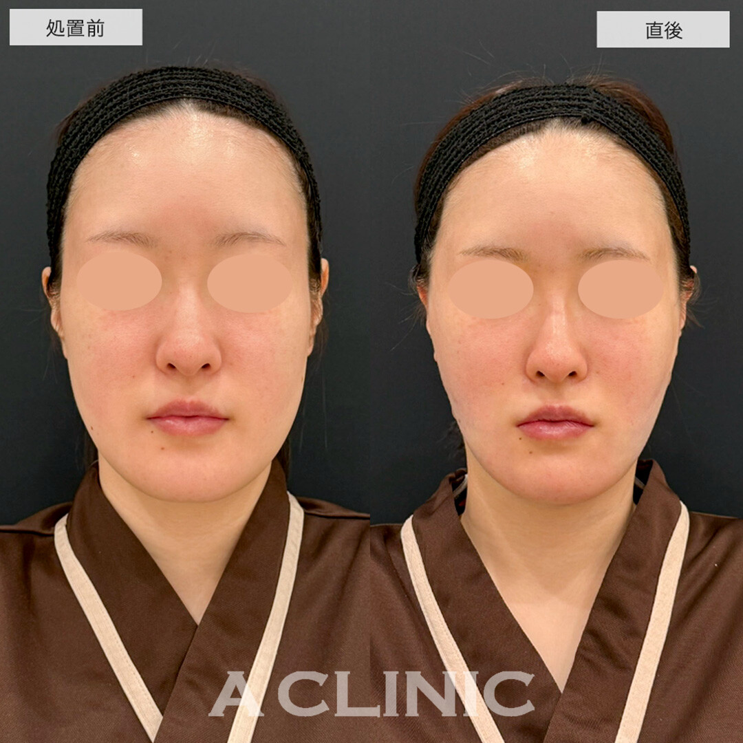 1day小顔脂肪吸引で直後から腫れ最小限でスッキリ小顔になりました!こちら処置前と直後の症例です(20代女性)