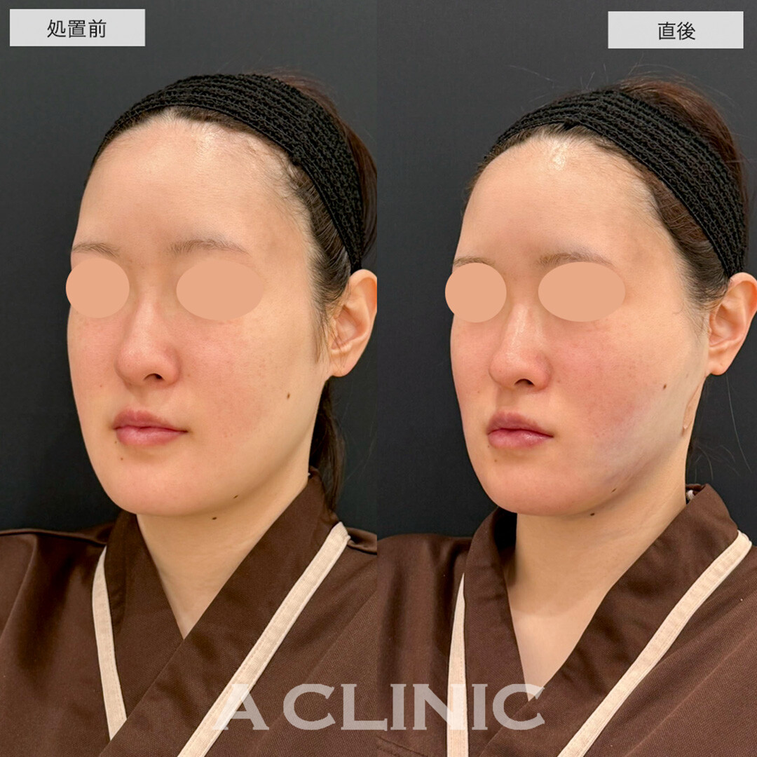 1day小顔脂肪吸引で直後から腫れ最小限でスッキリ小顔になりました!こちら処置前と直後の症例です(20代女性)