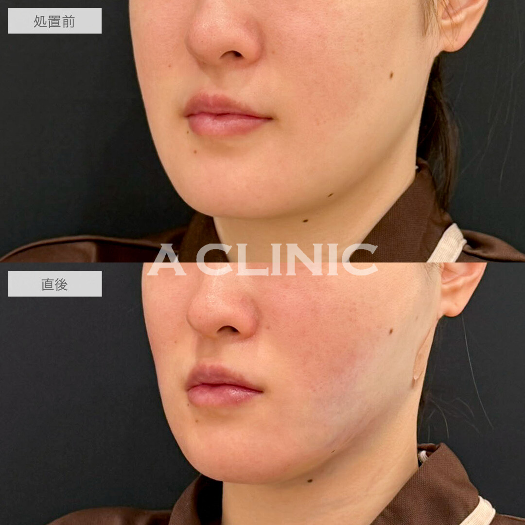 1day小顔脂肪吸引で直後から腫れ最小限でスッキリ小顔になりました!こちら処置前と直後の症例です(20代女性)
