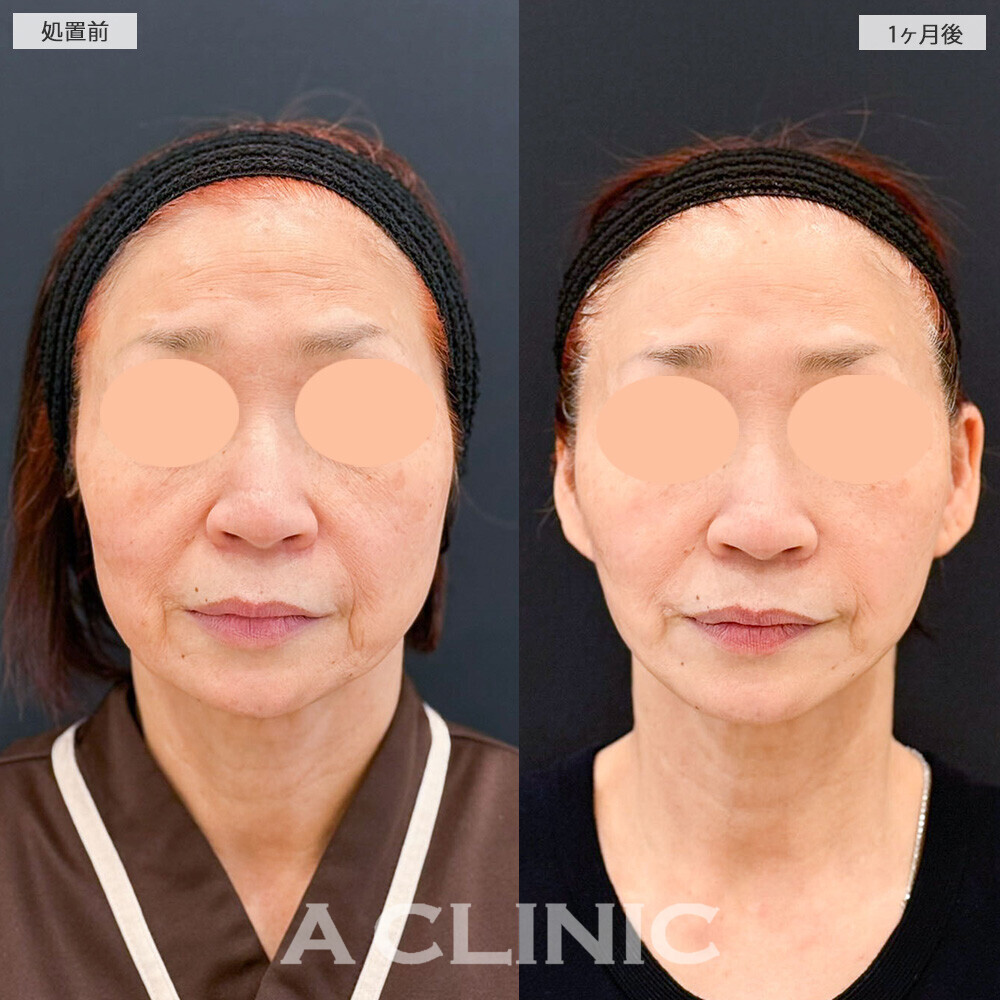 A式たるみ切開と1day小顔脂肪吸引でシワやたるみが改善され若返りました！こちら処置前と1ヶ月後の症例です(60代女性)