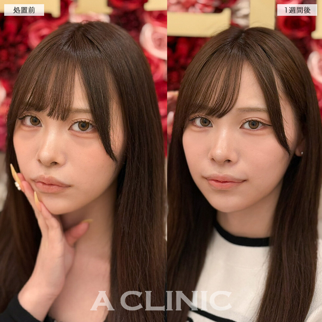 A式コンシーラー注射で濃い茶グマが1回でここまで改善！こちら処置前と1週間後の症例です(20代女性)