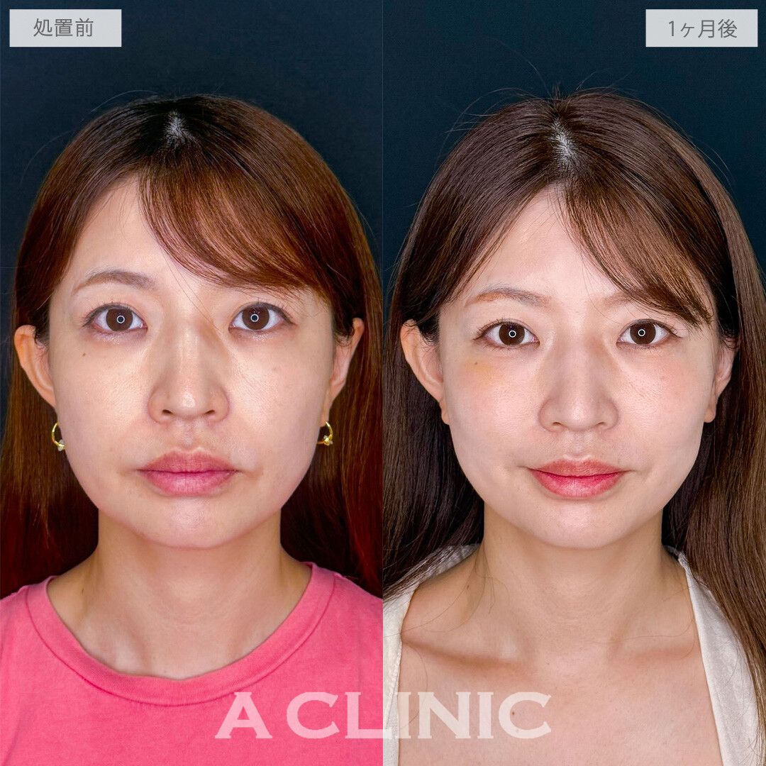 Aスレッドでたるみ感を緩和させて自然と若返った印象に！こちら処置前から1ヶ月後の症例です(40代女性)