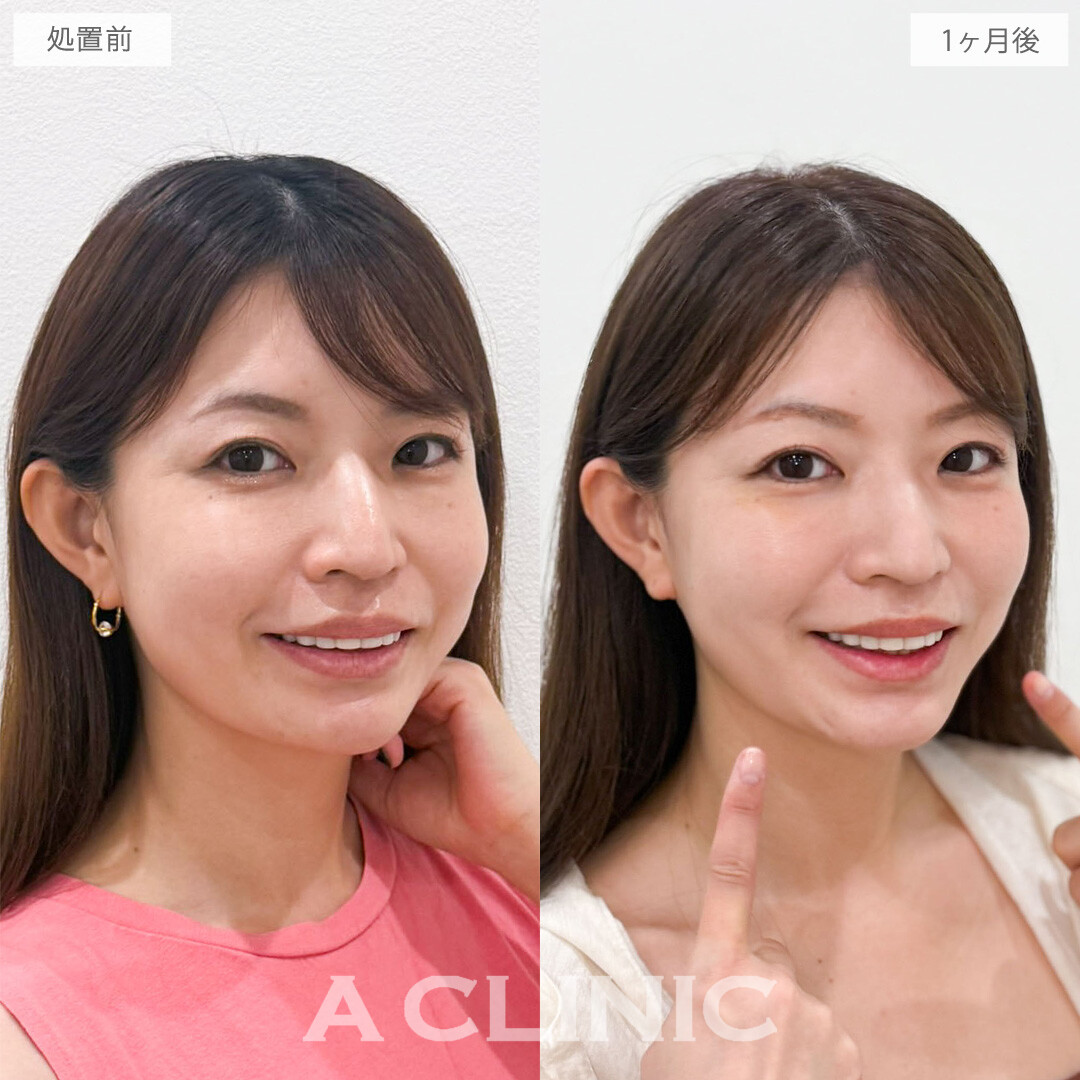 Aスレッドでたるみ感を緩和させて自然と若返った印象に！こちら処置前から1ヶ月後の症例です(40代女性)