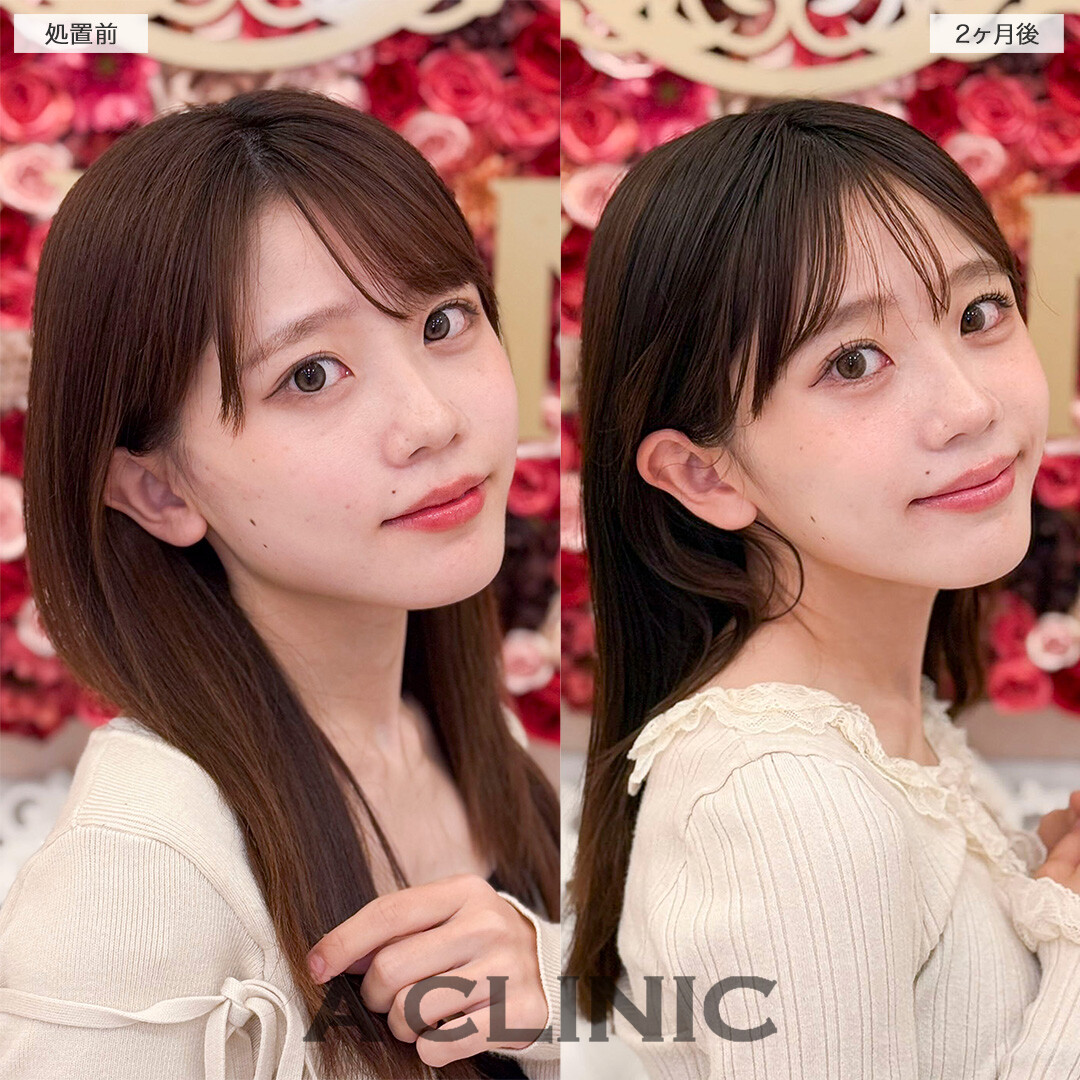 Aスレッドと小顔エラボトックスの併用ですっきりVフェイスへ！処置前と2ヶ月後の症例です(20代女性)