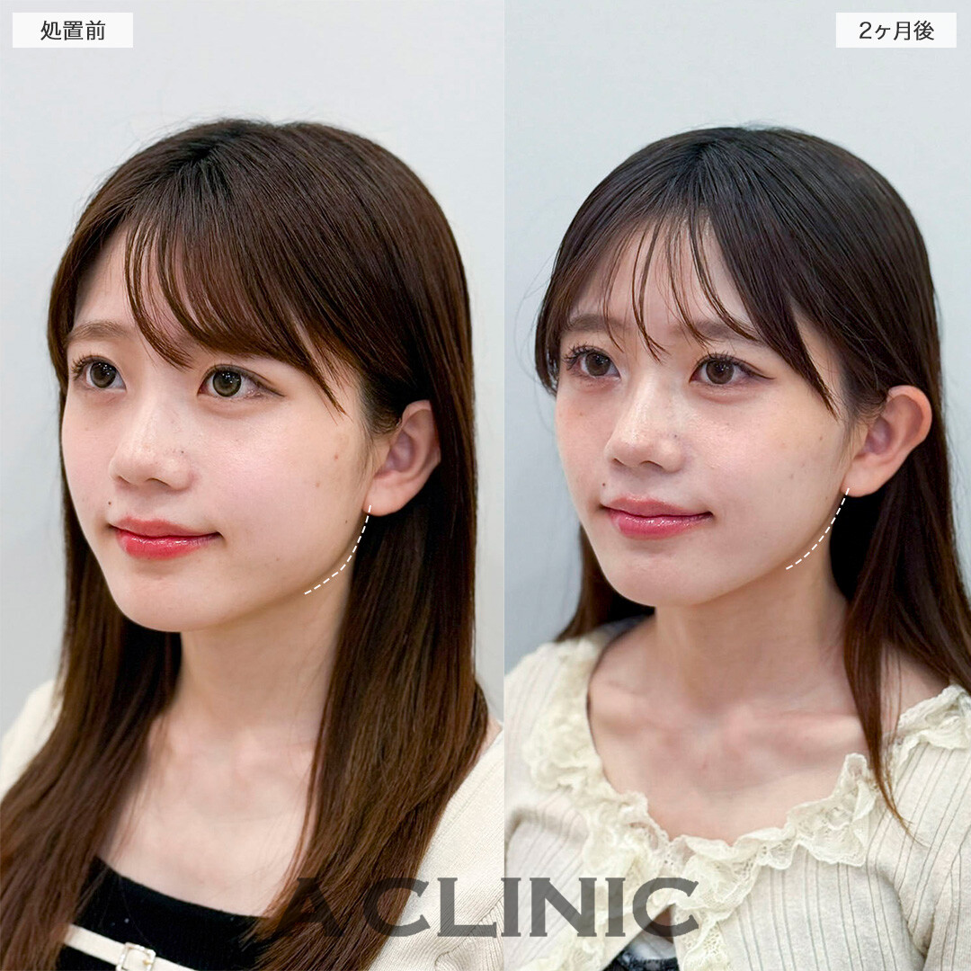 Aスレッドと小顔エラボトックスの併用ですっきりVフェイスへ！処置前と2ヶ月後の症例です(20代女性)