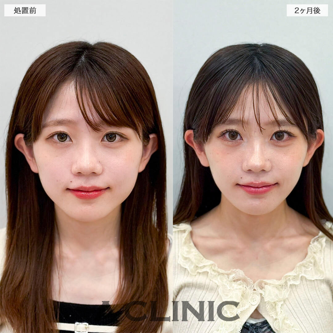 Aスレッドと小顔エラボトックスの併用ですっきりVフェイスへ！処置前と2ヶ月後の症例です(20代女性)