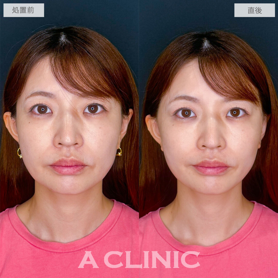 Aスレッドでたるみ感を緩和させて自然と若返った印象に！こちら処置前から1ヶ月後の症例です(40代女性)