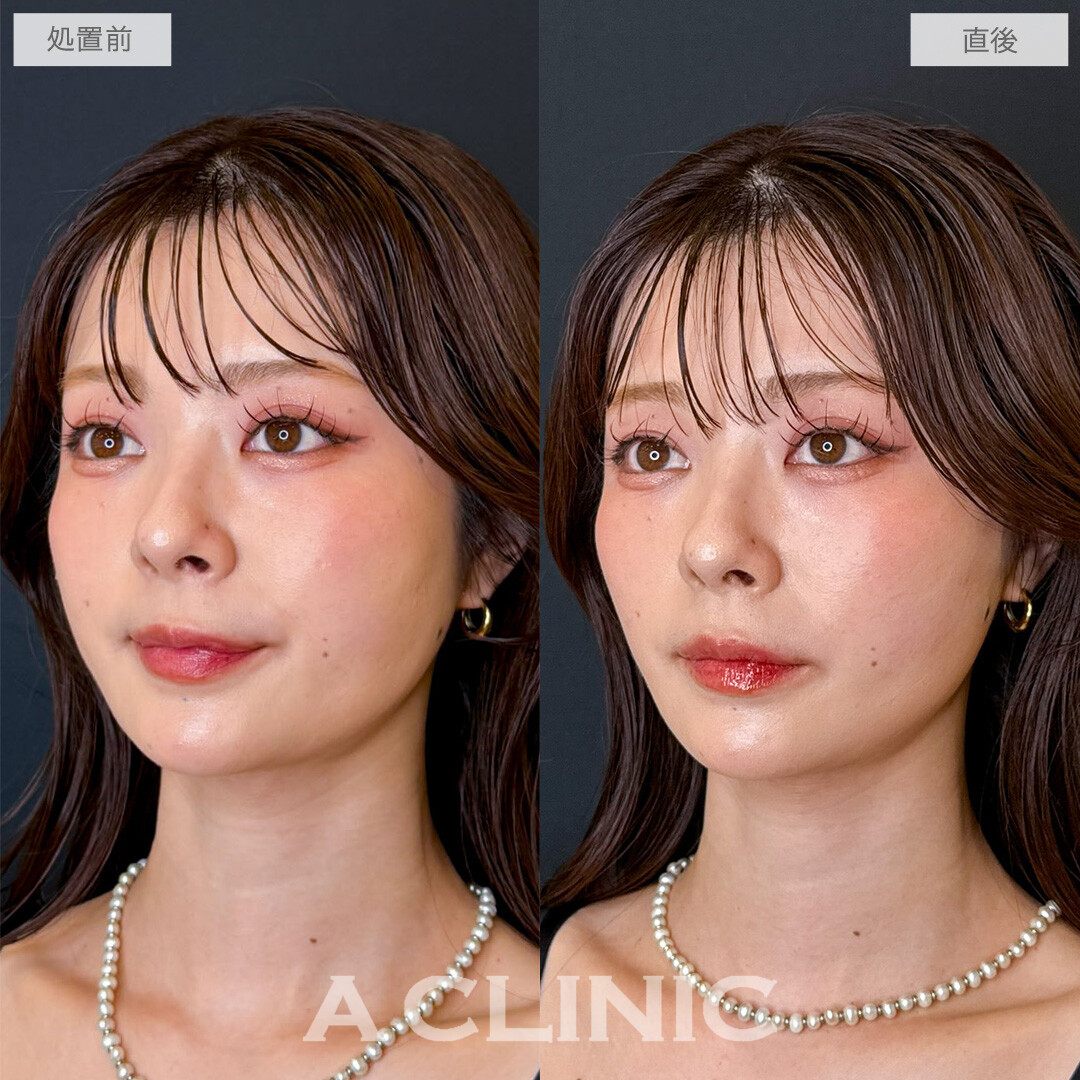 Aスレッドでパーツが引き立つシャープなフェイスラインに！こちら処置前と直後の症例です(20代女性)