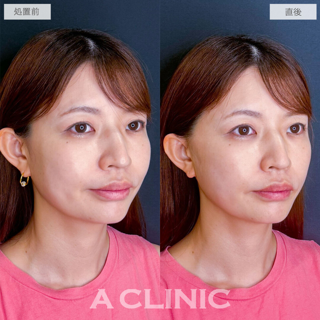 Aスレッドでたるみ感を緩和させて自然と若返った印象に！こちら処置前から1ヶ月後の症例です(40代女性)