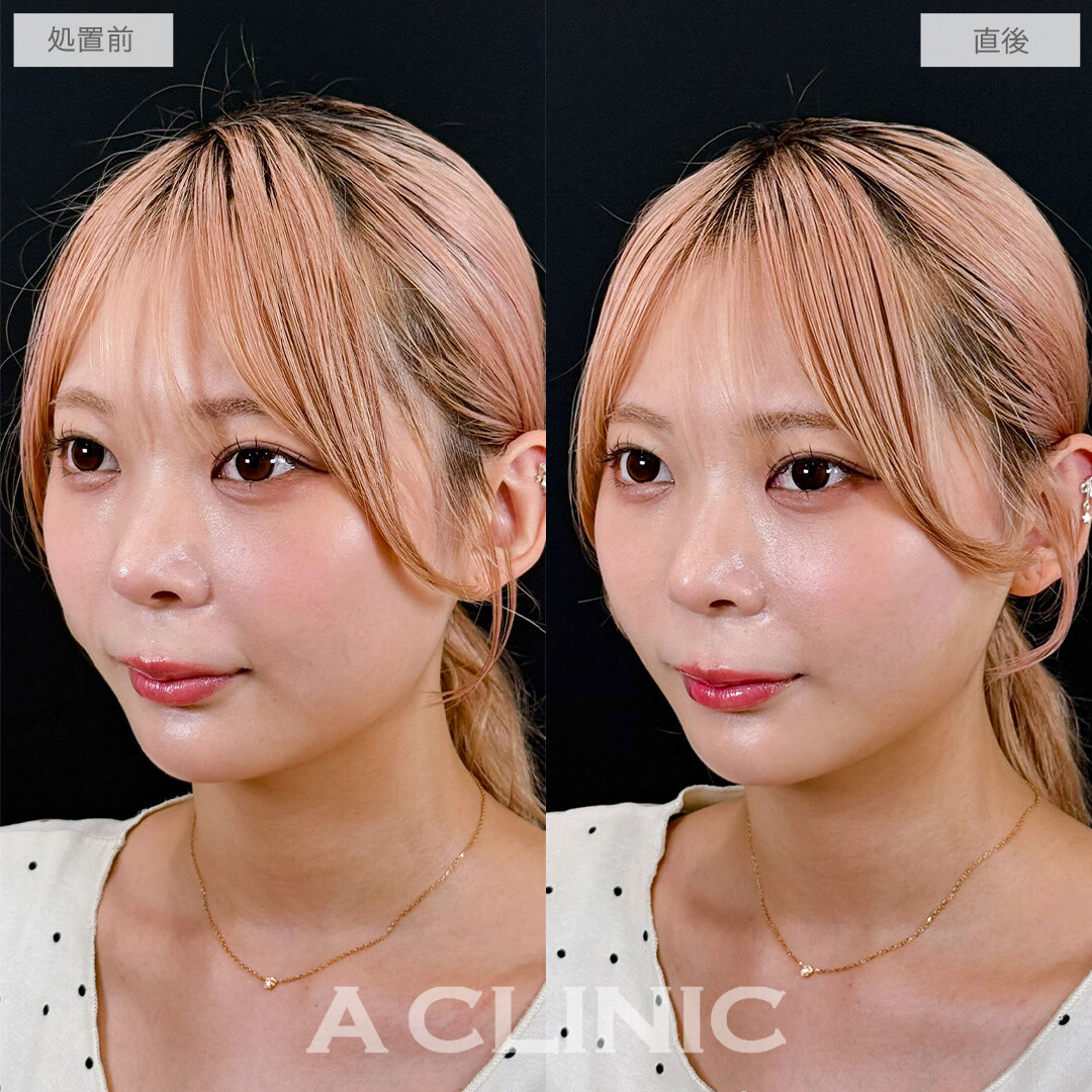 Aスレッドはたった15分でお顔の引き締まり効果を実感できます！こちら処置前と直後の症例です(20代女性)