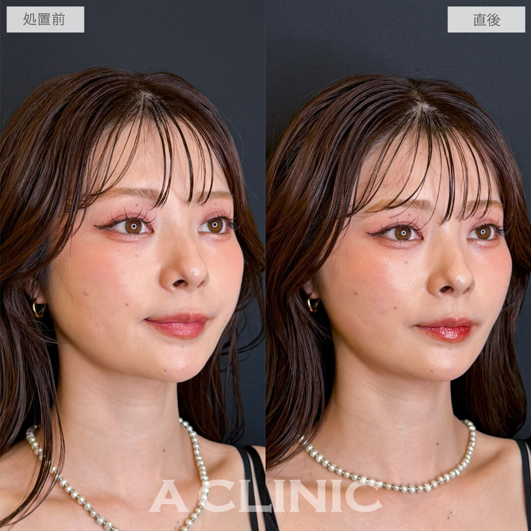 Aスレッドでパーツが引き立つシャープなフェイスラインに！こちら処置前と直後の症例です(20代女性)