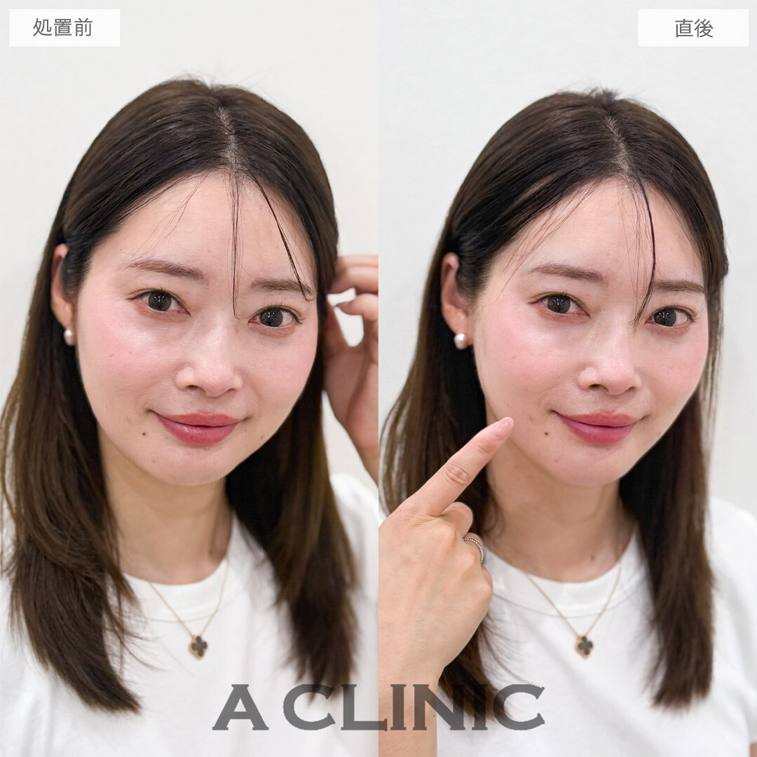 Aスレッドでひきつれ感ゼロで口元のもたつきを撃退！こちら処置前と直後の症例です(40代女性)