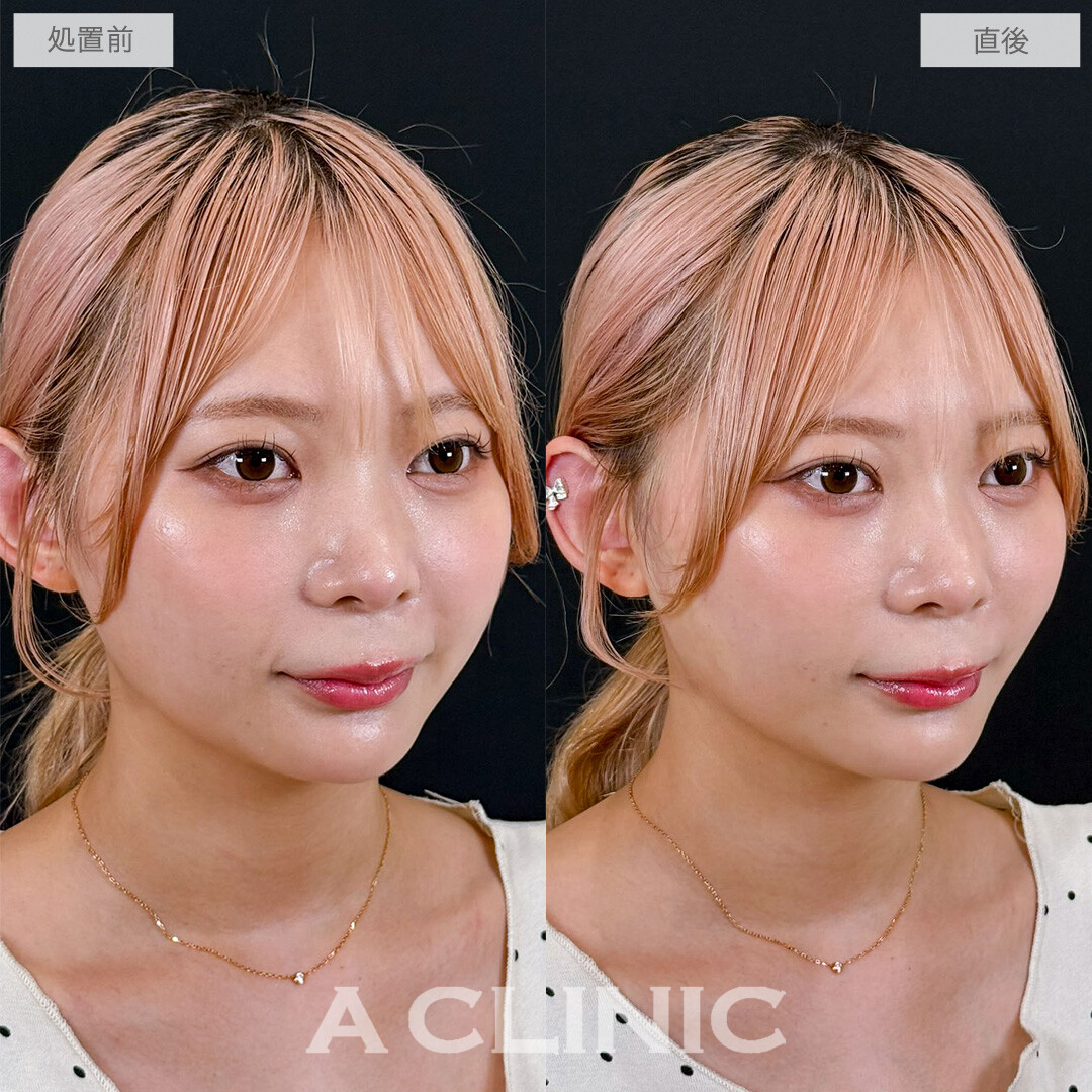Aスレッドはたった15分でお顔の引き締まり効果を実感できます！こちら処置前と直後の症例です(20代女性)