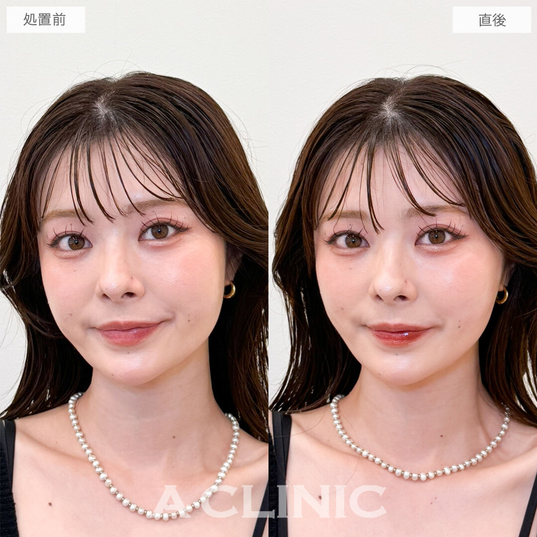 Aスレッドでパーツが引き立つシャープなフェイスラインに！こちら処置前と直後の症例です(20代女性)