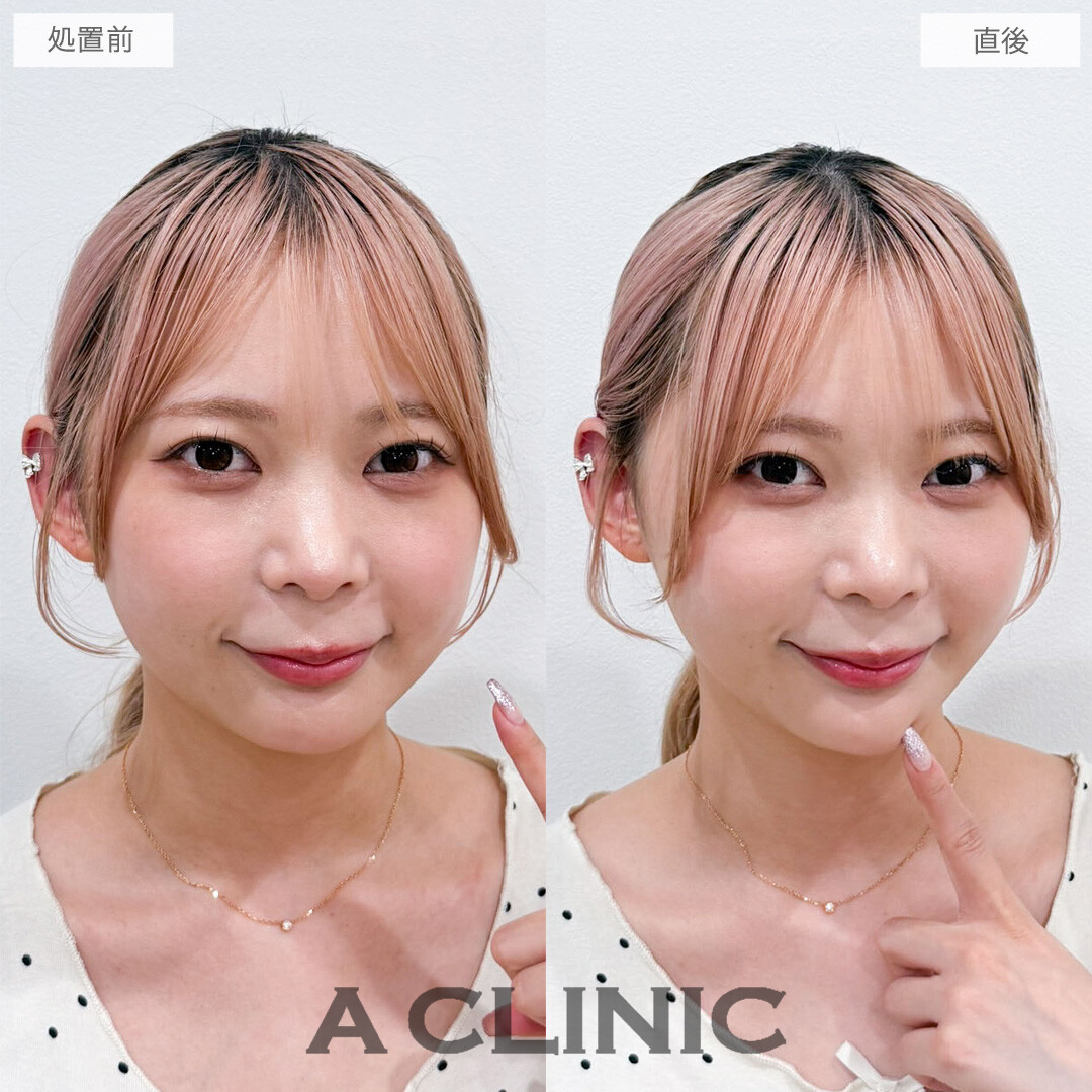 Aスレッドはたった15分でお顔の引き締まり効果を実感できます！こちら処置前と直後の症例です(20代女性)