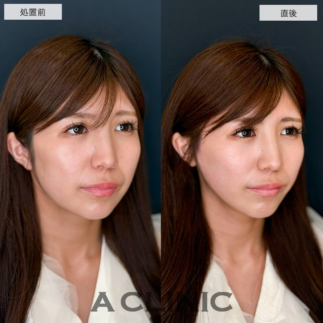 Aスレッドと頬へのヒアルロン酸注入で頬コケが改善しました!こちら処置前と直後の症例です(20代女性)