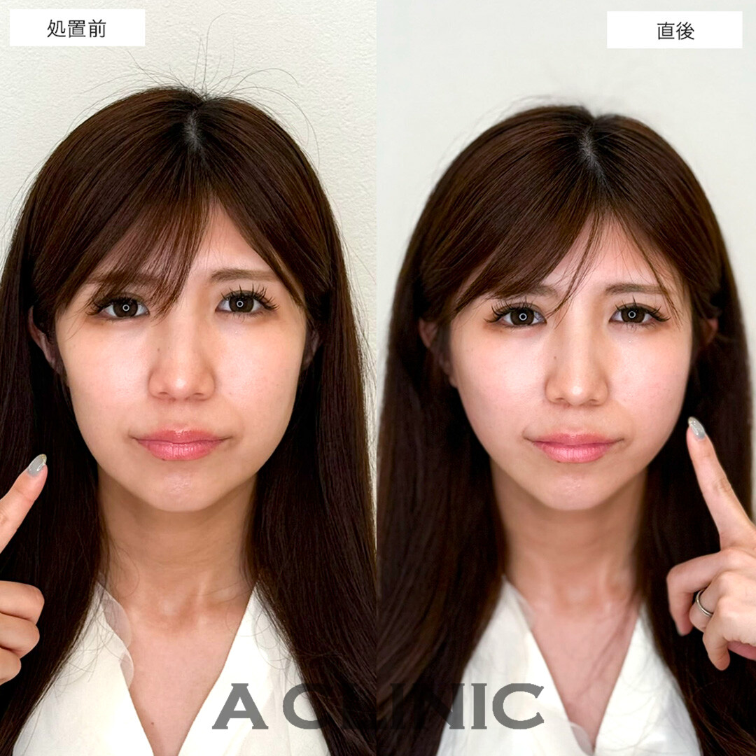 Aスレッドと頬へのヒアルロン酸注入で頬コケが改善しました!こちら処置前と直後の症例です(20代女性)