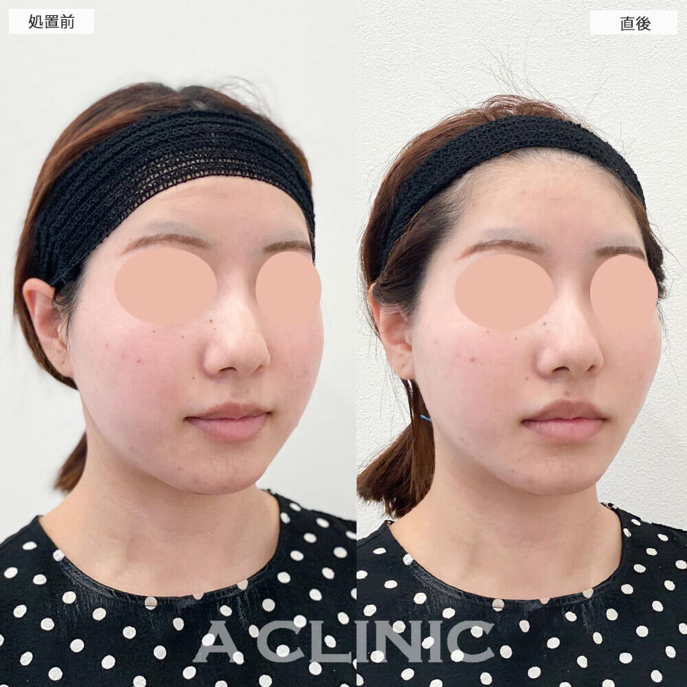 Aスレッドで下膨れ感が改善しました！こちら処置前と直後の症例です(20代女性)