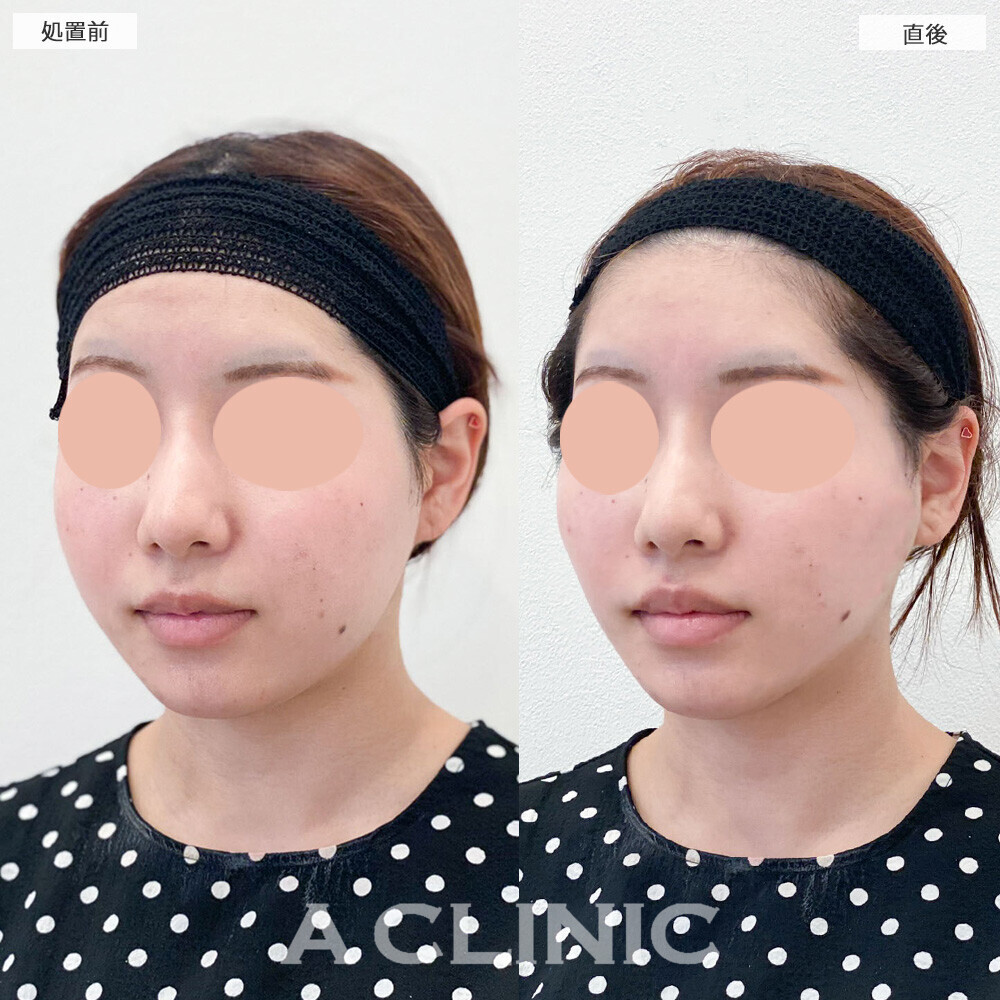 Aスレッドで下膨れ感が改善しました！こちら処置前と直後の症例です(20代女性)