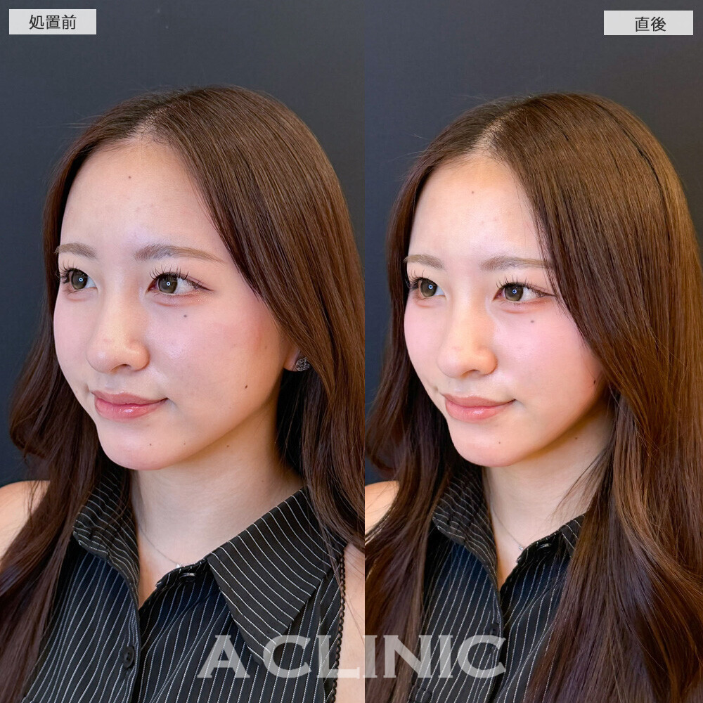 Aスレッドで余白がなくなってさらに可愛くなりました！こちら処置前と直後の症例です(20代女性)