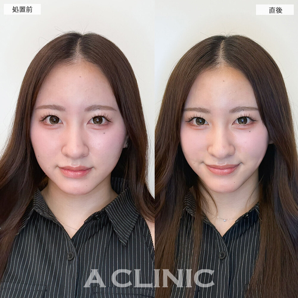 Aスレッドで余白がなくなってさらに可愛くなりました！こちら処置前と直後の症例です(20代女性)