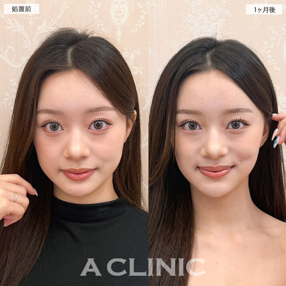 Aスレッドと小顔エラボトックスを組み合わせることでより小顔に！こちら処置前と1ヶ月後の症例です(20代女性)