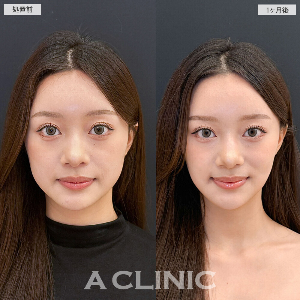 Aスレッドと小顔エラボトックスを組み合わせることでより小顔に！こちら処置前と1ヶ月後の症例です(20代女性)