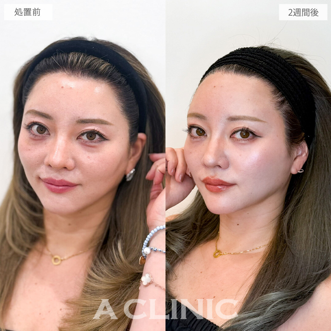 ヒアルロン酸カスタマイズメニューで額から頬までふっくらさせ影のない若々しさを叶えました！こちら処置前と2週間後の症例です(30代女性)