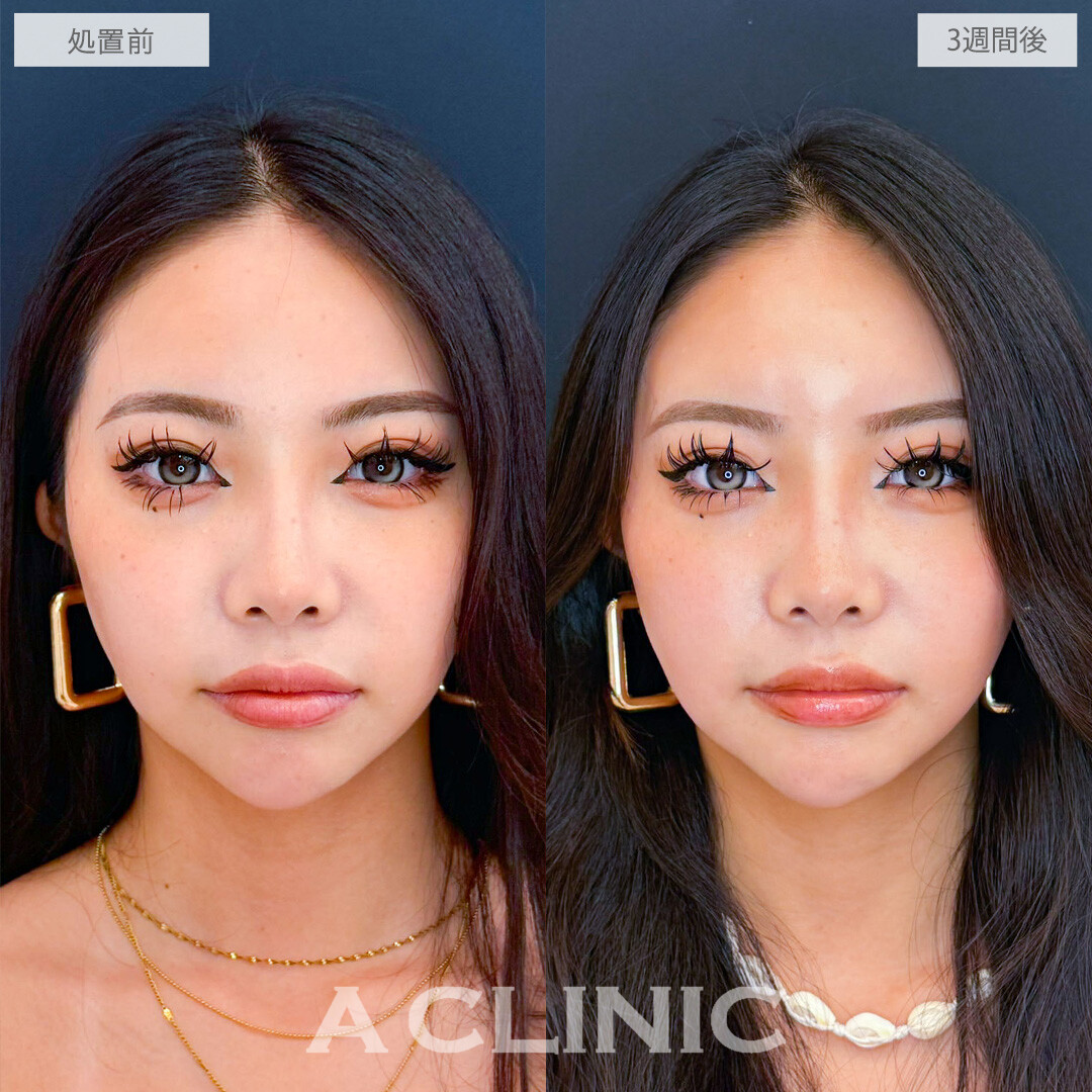 額出し(ヒアルロン酸注入)でぷっくりピュアなおでこに！こちら処置前と3週間後の症例です(20代女性)