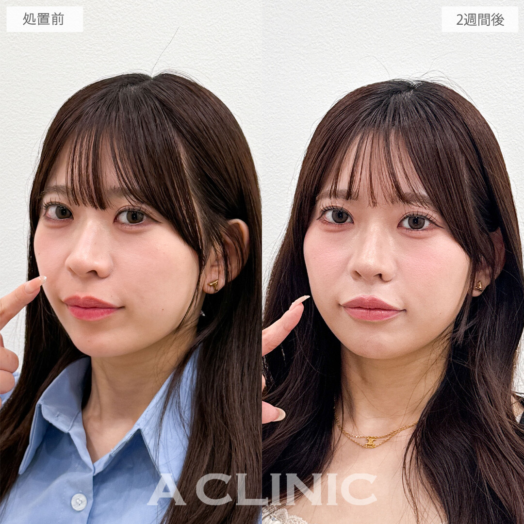 切らない人中短縮(Cカール形成術)で鼻下をキュッと短くし無敵の口元に！こちら処置前と2週間後の症例です(20代女性)