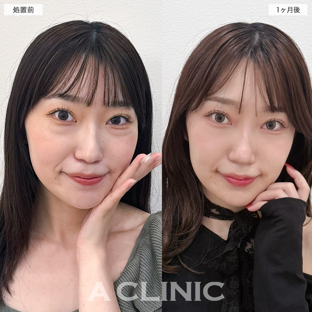 目の下のクマ取りでお疲れ顔を卒業！処置前と1ヶ月後の症例です(20代女性)