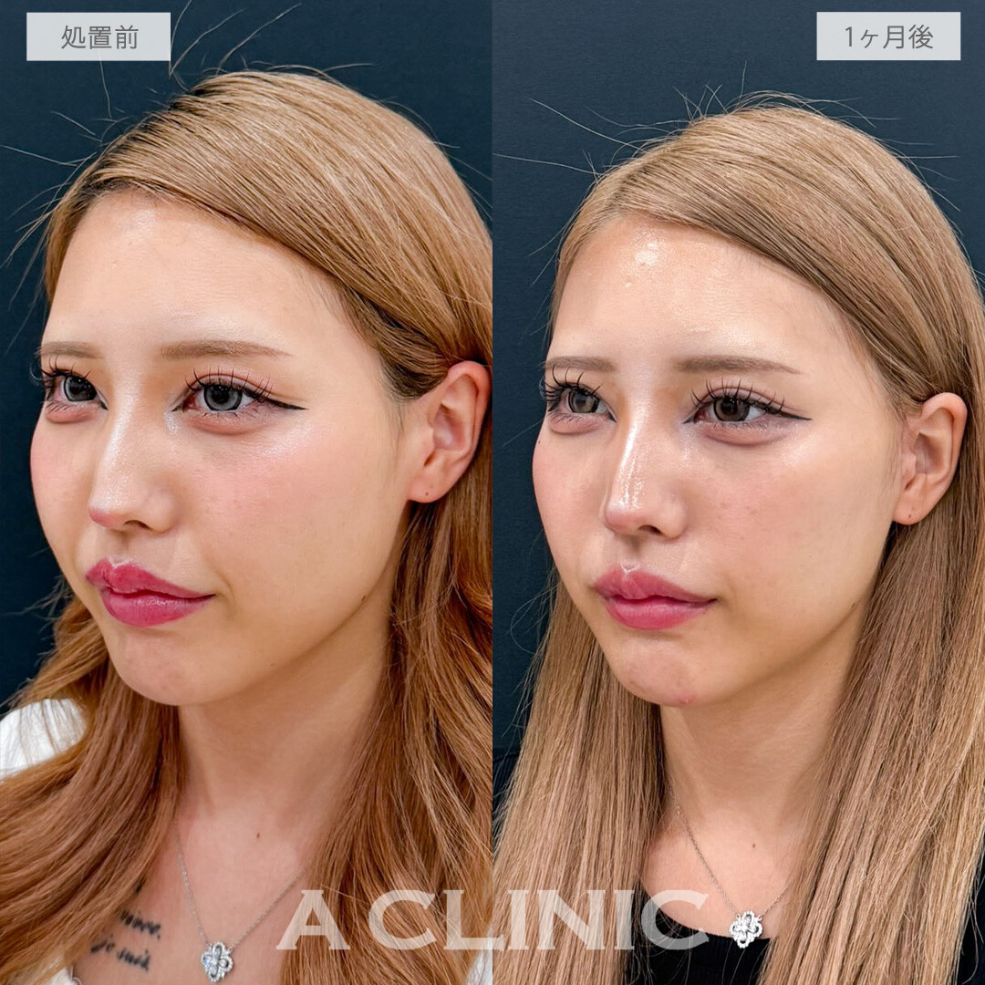【直後の傷跡あり】A式ナゾラリフトでたるみとほうれい線を根本改善！こちら処置前と1か月後の症例です(20代女性)