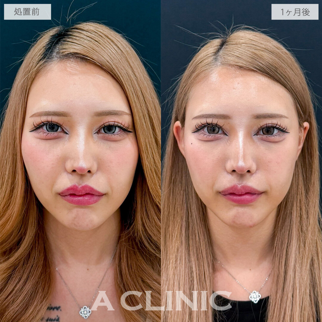 【直後の傷跡あり】A式ナゾラリフトでたるみとほうれい線を根本改善！こちら処置前と1か月後の症例です(20代女性)