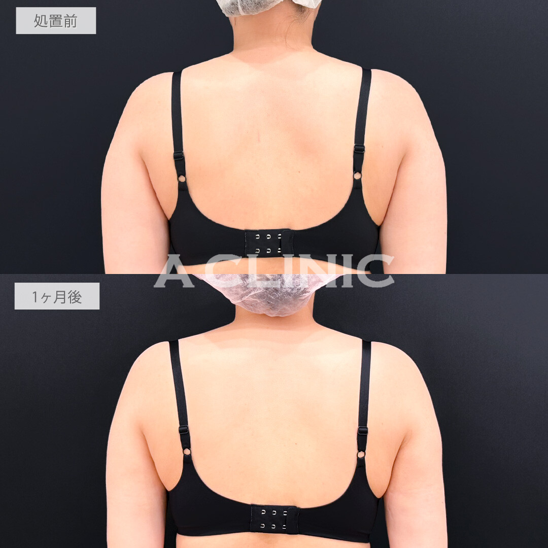 二の腕スリム脂肪吸引でゴツくなりがちな二の腕を女性らしい細さに！処置前と1ヶ月後の症例です(30代女性)