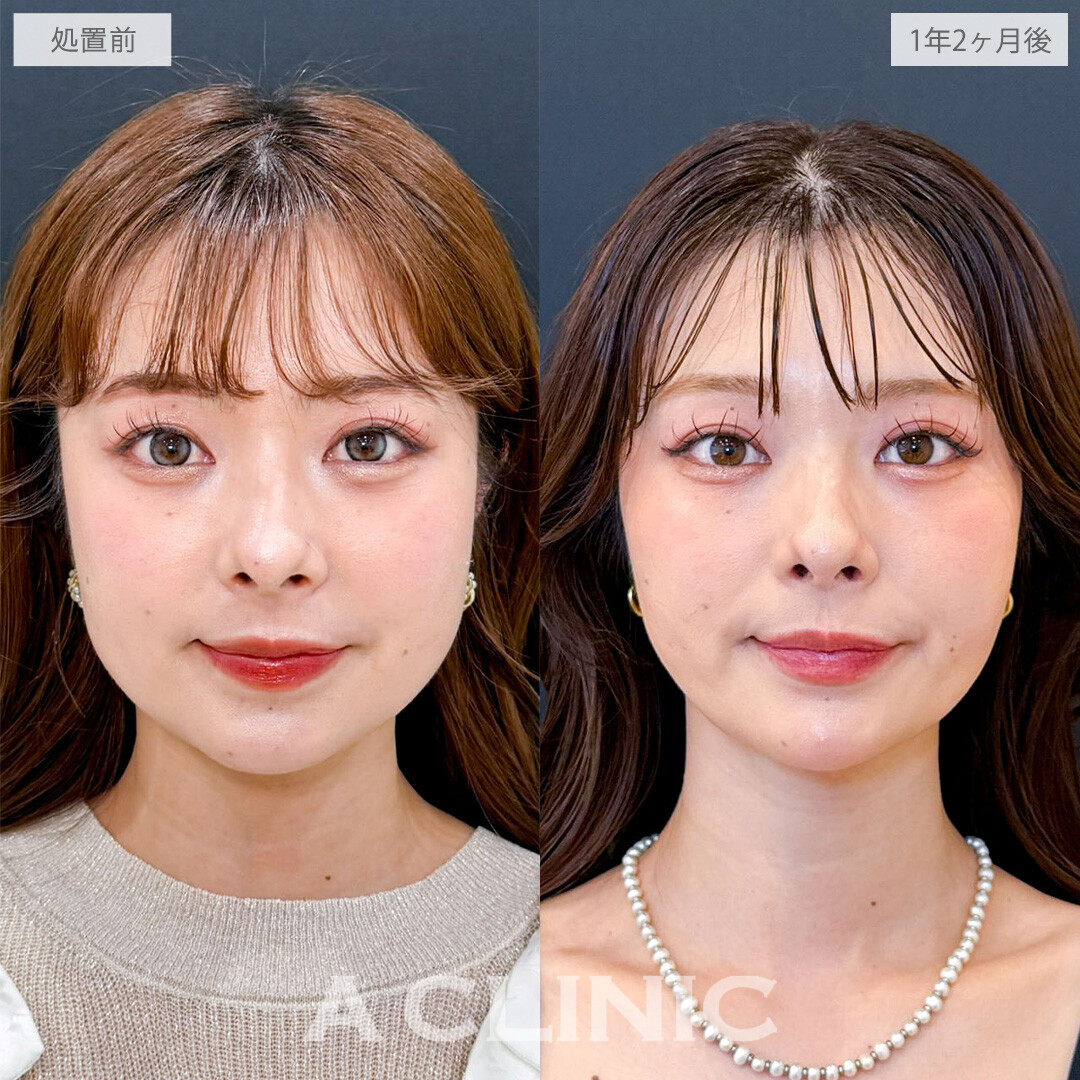 1day小顔脂肪吸引とバッカルファット除去術で隠れていた美しい骨格ラインを掘り起こしました！こちら処置前と1年2か月後の症例です(20代女性)