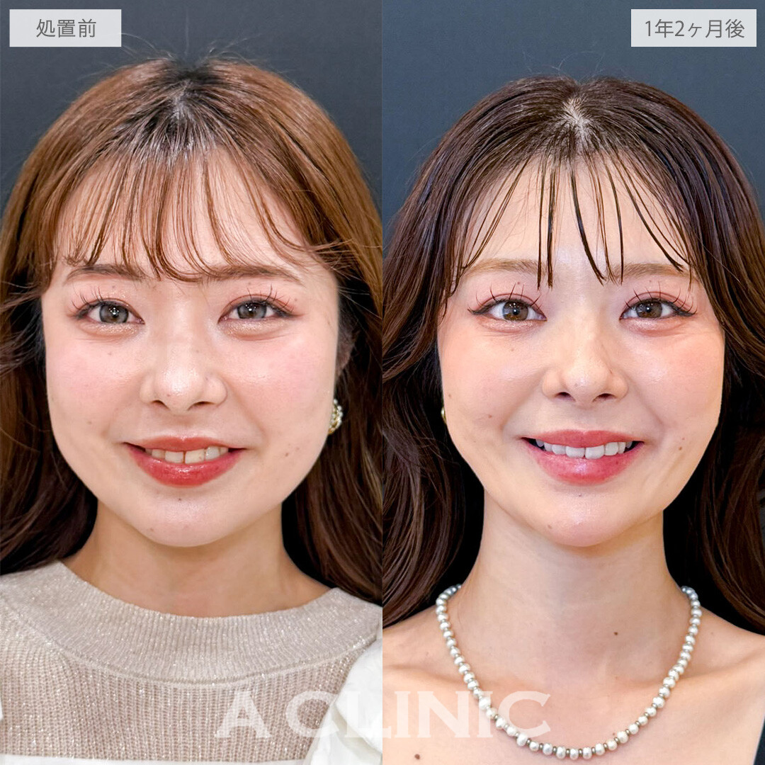 1day小顔脂肪吸引とバッカルファット除去術で隠れていた美しい骨格ラインを掘り起こしました！こちら処置前と1年2か月後の症例です(20代女性)