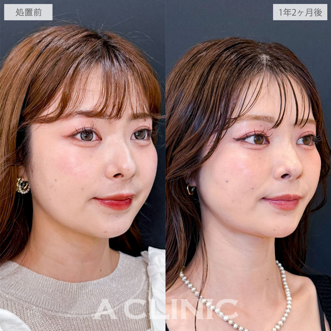 1day小顔脂肪吸引とバッカルファット除去術で隠れていた美しい骨格ラインを掘り起こしました！こちら処置前と1年2か月後の症例です(20代女性)