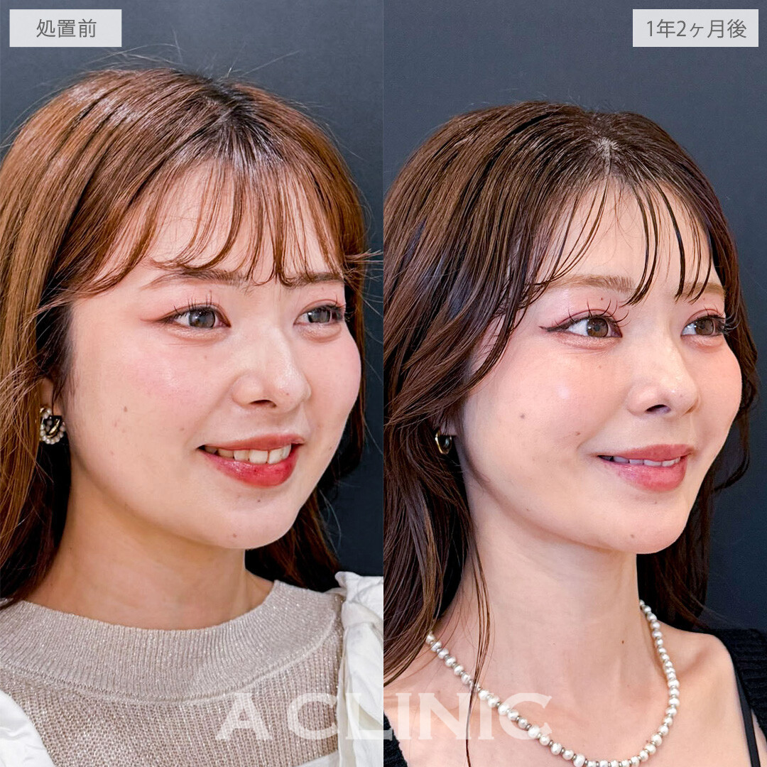 1day小顔脂肪吸引とバッカルファット除去術で隠れていた美しい骨格ラインを掘り起こしました！こちら処置前と1年2か月後の症例です(20代女性)