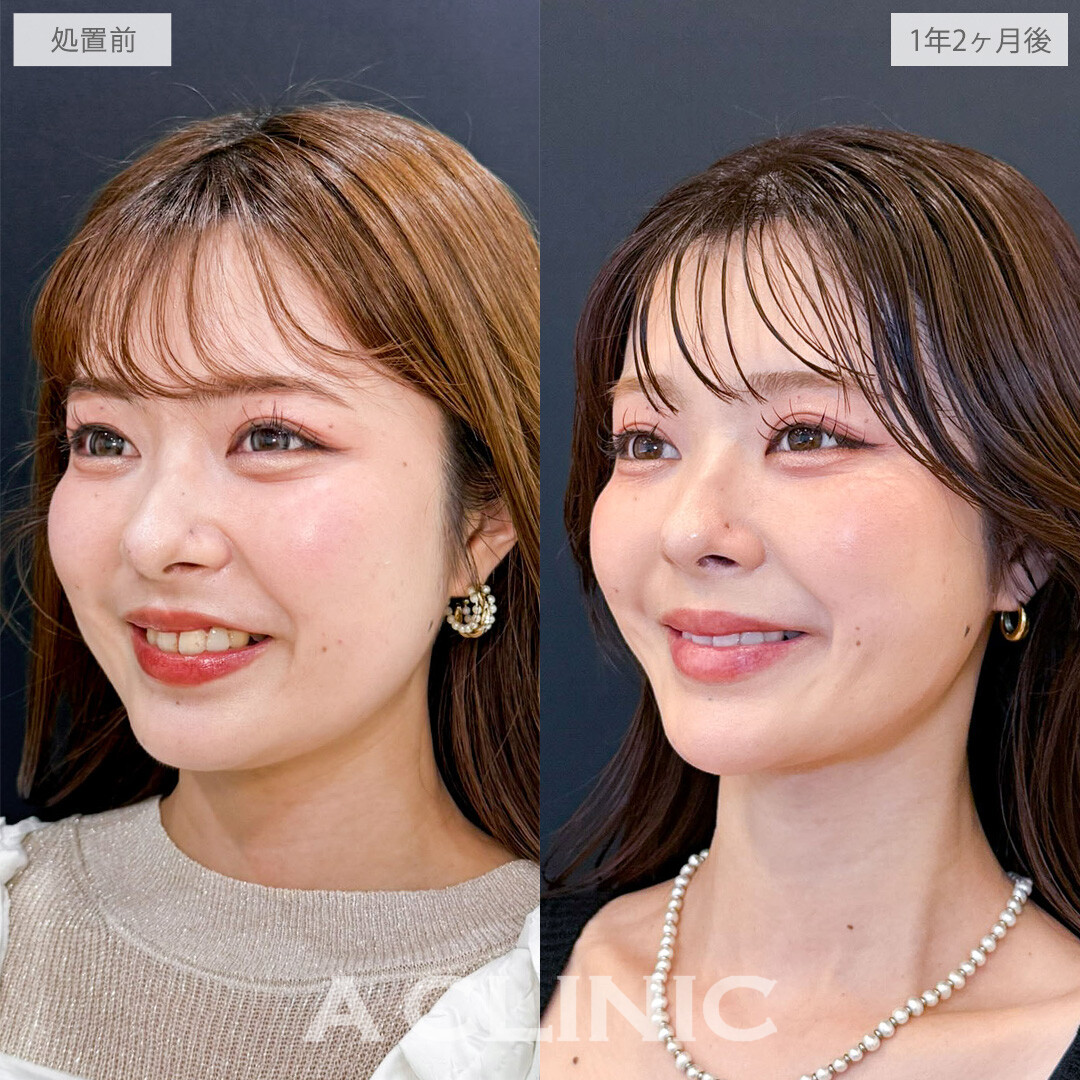 1day小顔脂肪吸引とバッカルファット除去術で隠れていた美しい骨格ラインを掘り起こしました！こちら処置前と1年2か月後の症例です(20代女性)