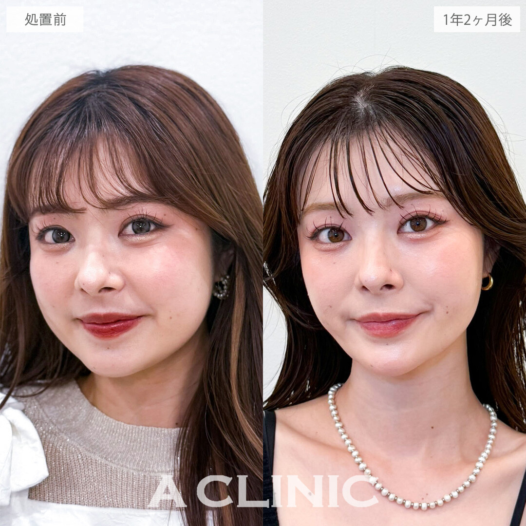 1day小顔脂肪吸引とバッカルファット除去術で隠れていた美しい骨格ラインを掘り起こしました！こちら処置前と1年2か月後の症例です(20代女性)