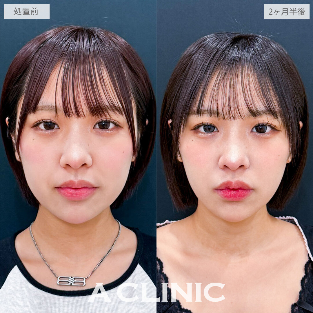 1day小顔脂肪吸引で余分な脂肪をなくして一気に垢抜けました！こちら処置前と2か月半後の症例です(20代女性)