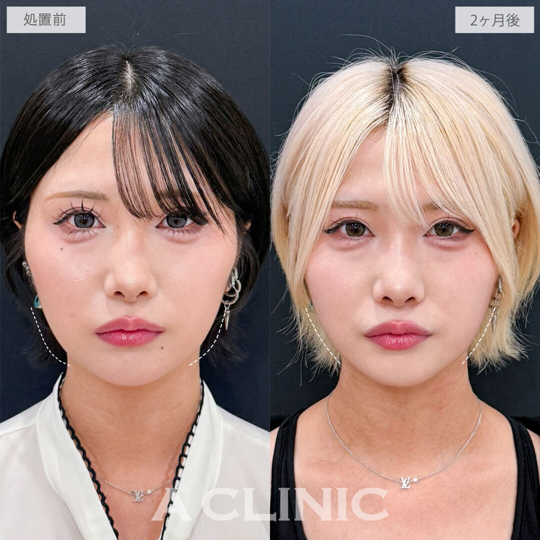 1day小顔脂肪吸引でさらにシャープな印象になりました！こちら処置前と2か月後の症例です(20代女性)