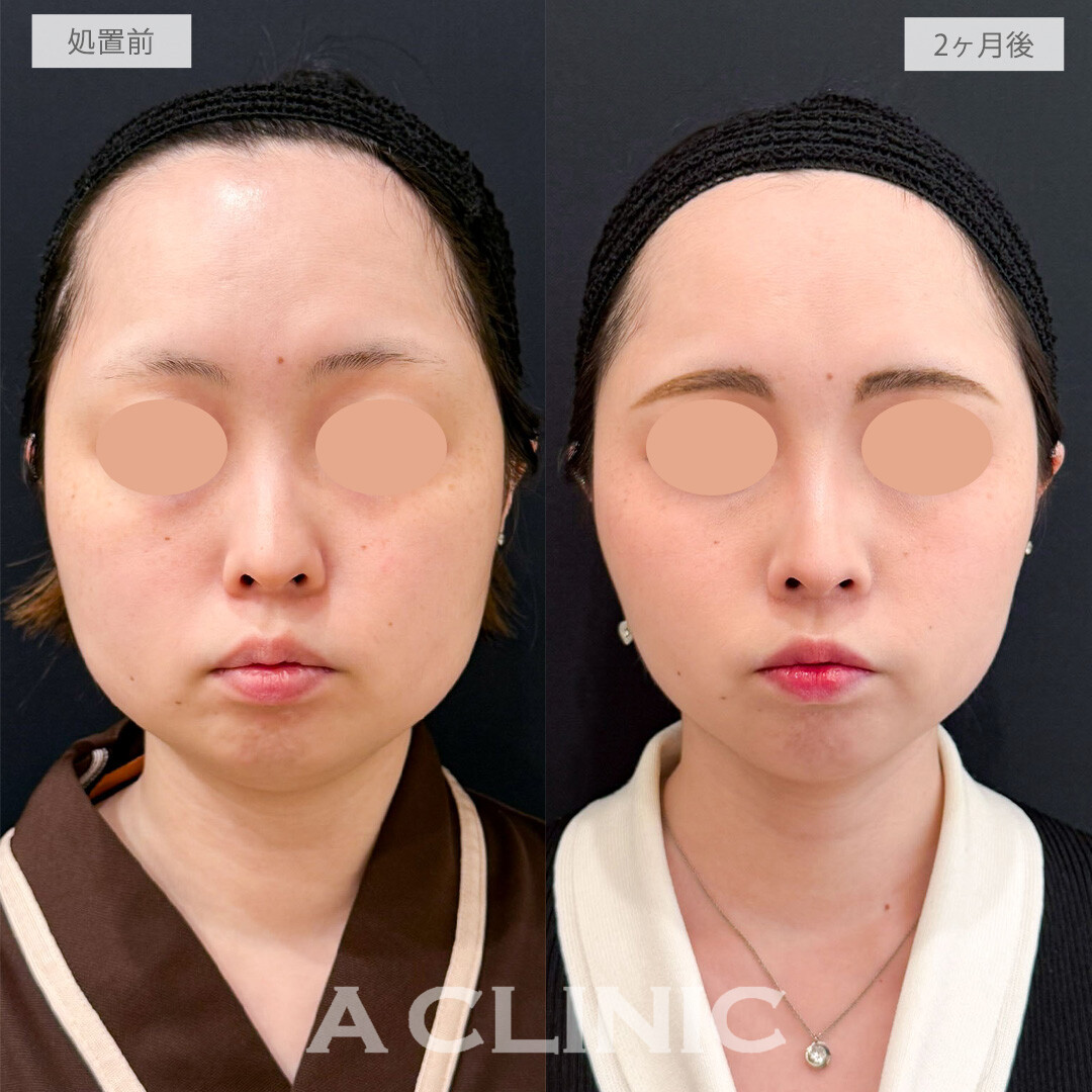 1day小顔脂肪吸引で下顔面がすっきりしてお顔全体の余白が消えました！こちら処置前と2か月後の症例です(20代女性)
